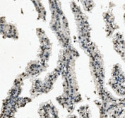 IHC staining of FFPE human renal cancer with RNA Helicase A antibody. HIER: boil tissue sections in pH8 EDTA for 20 min and allow to cool before testing.