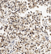 IHC staining of FFPE human testicular cancer with DNAJA2 antibody. HIER: boil tissue sections in pH8 EDTA for 20 min and allow to cool before testing.