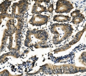 IHC staining of FFPE human rectal cancer with DNAJA2 antibody. HIER: boil tissue sections in pH8 EDTA for 20 min and allow to cool before testing.