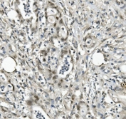 IHC staining of FFPE human rectal cancer with EAPP antibody. HIER: boil tissue sections in pH8 EDTA for 20 min and allow to cool before testing.