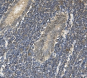 IHC staining of FFPE human rectal cancer with EAPP antibody. HIER: boil tissue sections in pH8 EDTA for 20 min and allow to cool before testing.