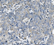 IHC staining of FFPE human lung cancer with TTC11 antibody. HIER: boil tissue sections in pH8 EDTA for 20 min and allow to cool before testing.