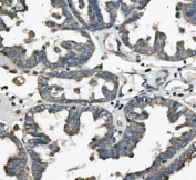 IHC staining of FFPE human ovarian cancer with TTC11 antibody. HIER: boil tissue sections in pH8 EDTA for 20 min and allow to cool before testing.