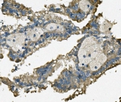IHC staining of FFPE human renal cancer with TTC11 antibody. HIER: boil tissue sections in pH8 EDTA for 20 min and allow to cool before testing.
