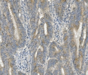 IHC staining of FFPE human rectal cancer with Willin antibody. HIER: boil tissue sections in pH8 EDTA for 20 min and allow to cool before testing.