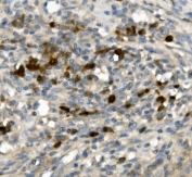 IHC staining of FFPE human rectal cancer with GFI1 antibody. HIER: boil tissue sections in pH8 EDTA for 20 min and allow to cool before testing.