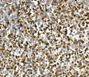 IHC staining of FFPE human testicular cancer with HGS antibody. HIER: boil tissue sections in pH8 EDTA for 20 min and allow to cool before testing.