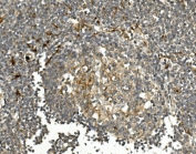 IHC staining of FFPE human rectal cancer with HGS antibody. HIER: boil tissue sections in pH8 EDTA for 20 min and allow to cool before testing.