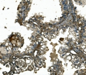 IHC staining of FFPE human renal cancer with IFT88 antibody. HIER: boil tissue sections in pH8 EDTA for 20 min and allow to cool before testing.
