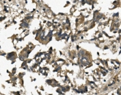 IHC staining of FFPE human rectal cancer with CD123 antibody. HIER: boil tissue sections in pH8 EDTA for 20 min and allow to cool before testing.