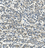 IHC staining of FFPE human liver cancer with LDL Receptor antibody. HIER: boil tissue sections in pH8 EDTA for 20 min and allow to cool before testing.