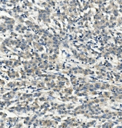IHC staining of FFPE human liver cancer with LDL Receptor antibody. HIER: boil tissue sections in pH8 EDTA for 20 min and allow to cool before testing.