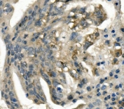 IHC staining of FFPE human rectal cancer with LDL Receptor antibody. HIER: boil tissue sections in pH8 EDTA for 20 min and allow to cool before testing.