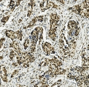 IHC staining of FFPE human breast cancer with MCM5 antibody. HIER: boil tissue sections in pH8 EDTA for 20 min and allow to cool before testing.