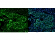 Immunofluorescent staining of FFPE human breast cancer with MCM5 antibody (green) and DAPI nuclear stain (blue). HIER: steam section in pH8 EDTA for 20 min.