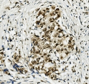 IHC staining of FFPE human breast cancer with MCM5 antibody. HIER: boil tissue sections in pH8 EDTA for 20 min and allow to cool before testing.
