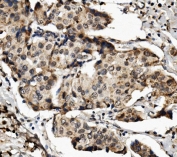IHC staining of FFPE human breast cancer with MED4 antibody. HIER: boil tissue sections in pH8 EDTA for 20 min and allow to cool before testing.