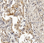 IHC staining of FFPE human rectal cancer with MED4 antibody. HIER: boil tissue sections in pH8 EDTA for 20 min and allow to cool before testing.