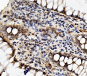 IHC staining of FFPE human rectal cancer with MED4 antibody. HIER: boil tissue sections in pH8 EDTA for 20 min and allow to cool before testing.