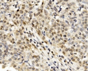 IHC staining of FFPE human liver cancer with MNT antibody. HIER: boil tissue sections in pH8 EDTA for 20 min and allow to cool before testing.