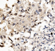 IHC staining of FFPE human liver cancer with MNT antibody. HIER: boil tissue sections in pH8 EDTA for 20 min and allow to cool before testing.