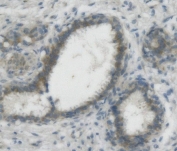 IHC staining of FFPE human breast cancer with Nectin 2 antibody. HIER: boil tissue sections in pH8 EDTA for 20 min and allow to cool before testing.