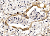 IHC staining of FFPE human rectal cancer with Nectin 3 antibody. HIER: boil tissue sections in pH8 EDTA for 20 min and allow to cool before testing.