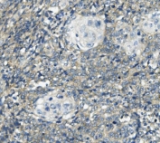 IHC staining of FFPE human lung cancer with PHEX antibody. HIER: boil tissue sections in pH8 EDTA for 20 min and allow to cool before testing.