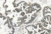 IHC staining of FFPE human ovarian cancer with PHEX antibody. HIER: boil tissue sections in pH8 EDTA for 20 min and allow to cool before testing.