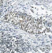 IHC staining of FFPE human gastric cancer with PRDM5 antibody. HIER: boil tissue sections in pH8 EDTA for 20 min and allow to cool before testing.
