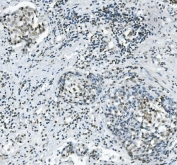 IHC staining of FFPE human gastric cancer with PRDM5 antibody. HIER: boil tissue sections in pH8 EDTA for 20 min and allow to cool before testing.