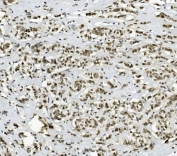 IHC staining of FFPE human breast cancer with PRDM5 antibody. HIER: boil tissue sections in pH8 EDTA for 20 min and allow to cool before testing.