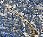 IHC staining of FFPE human lung cancer with RBPMS antibody. HIER: boil tissue sections in pH8 EDTA for 20 min and allow to cool before testing.