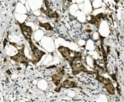 IHC staining of FFPE human breast cancer with RBPMS antibody. HIER: boil tissue sections in pH8 EDTA for 20 min and allow to cool before testing.