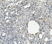 IHC staining of FFPE human rectal cancer with Kallistatin antibody. HIER: boil tissue sections in pH8 EDTA for 20 min and allow to cool before testing.