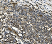 IHC staining of FFPE human breast cancer with TRIM25 antibody. HIER: boil tissue sections in pH8 EDTA for 20 min and allow to cool before testing.