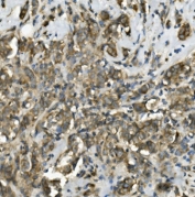IHC staining of FFPE human breast cancer with TRIM25 antibody. HIER: boil tissue sections in pH8 EDTA for 20 min and allow to cool before testing.