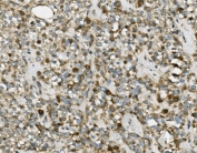 IHC staining of FFPE human pancreatic cancer with TRIM25 antibody. HIER: boil tissue sections in pH8 EDTA for 20 min and allow to cool before testing.