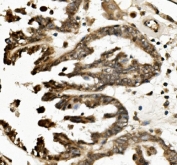 IHC staining of FFPE human ovarian cancer with TXNIP antibody. HIER: boil tissue sections in pH8 EDTA for 20 min and allow to cool before testing.