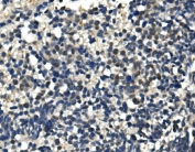IHC staining of FFPE human lung cancer with ULK1 antibody. HIER: boil tissue sections in pH8 EDTA for 20 min and allow to cool before testing.