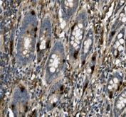 IHC staining of FFPE human rectal cancer with USP44 antibody. HIER: boil tissue sections in pH8 EDTA for 20 min and allow to cool before testing.