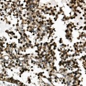 IHC staining of FFPE human testis cancer with USP44 antibody. HIER: boil tissue sections in pH8 EDTA for 20 min and allow to cool before testing.