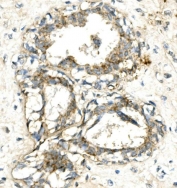 IHC staining of FFPE human breast cancer with VPS4A antibody. HIER: boil tissue sections in pH8 EDTA for 20 min and allow to cool before testing.