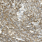 IHC staining of FFPE human lung cancer with VPS4A antibody. HIER: boil tissue sections in pH8 EDTA for 20 min and allow to cool before testing.