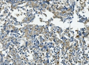 IHC staining of FFPE human lung cancer with VPS4B antibody. HIER: boil tissue sections in pH8 EDTA for 20 min and allow to cool before testing.