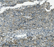 IHC staining of FFPE human lung cancer with VPS4B antibody. HIER: boil tissue sections in pH8 EDTA for 20 min and allow to cool before testing.