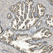 IHC staining of FFPE human prostate cancer with ZFP42 antibody. HIER: boil tissue sections in pH8 EDTA for 20 min and allow to cool before testing.