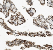 IHC staining of FFPE human renal cancer with ZFP42 antibody. HIER: boil tissue sections in pH8 EDTA for 20 min and allow to cool before testing.
