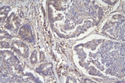 IHC staining of FFPE human rectal cancer with CD46 antibody. HIER: boil tissue sections in pH8 EDTA for 20 min and allow to cool before testing.