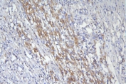 IHC staining of FFPE human liver cancer with CD46 antibody. HIER: boil tissue sections in pH8 EDTA for 20 min and allow to cool before testing.